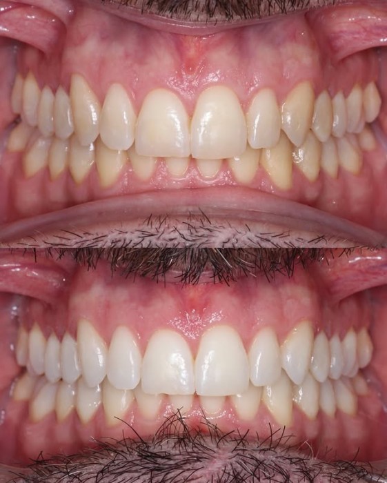 Blanqueamiento Dental: Una sonrisa brillante