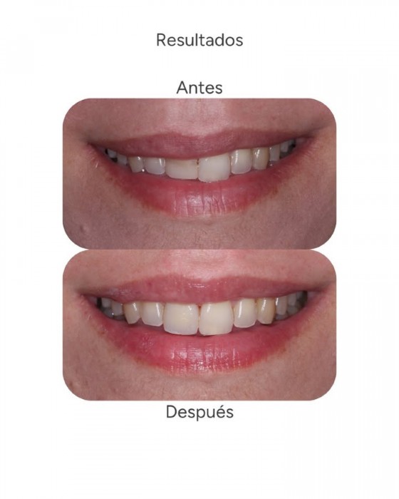 Carillas dentales por rotura de diente y corregir alteraciones