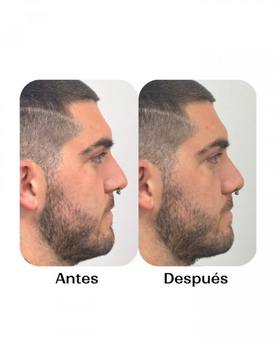 Cirugía ortognática para tratar las apneas del sueño