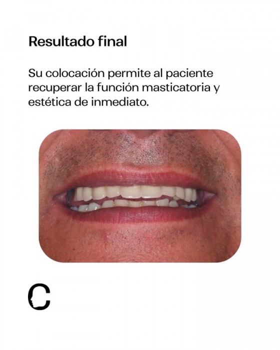 Implantes dentales mediante cirugía guiada