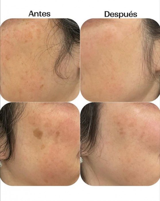 Tratamiento láser IPL: una piel radiante en Otoño