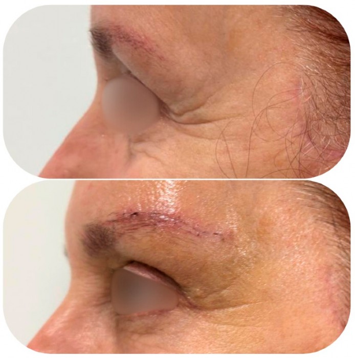 Lifting de cejas: rejuvenece tu mirada sin perder tu esencia