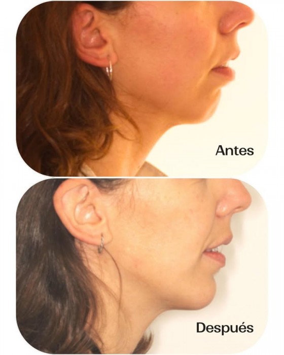 Mentoplastia para cambiar la forma del mentón