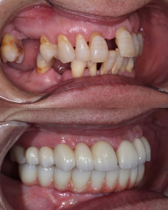 Rehabilitación oral con implantes de carga inmediata y prótesis
