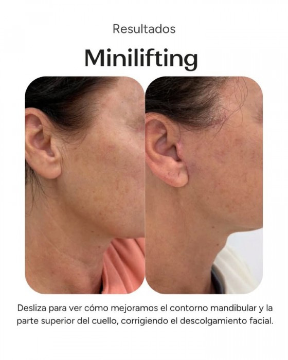 Tratamiendo de Minilifting para mejorar la piel