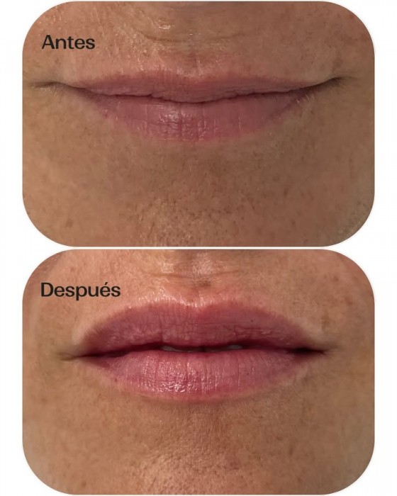 Tratamiento con ácido hialurónico en labios