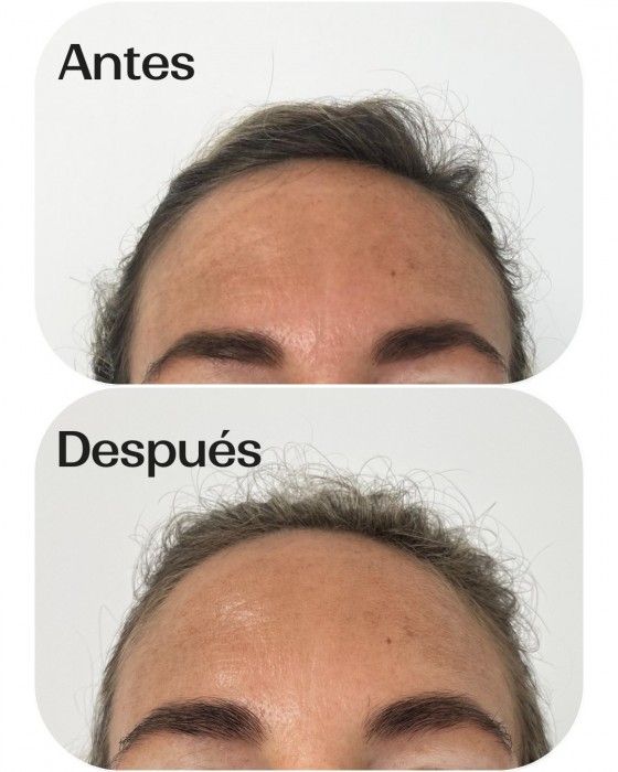 Tratamiento de arrugas de expresión
