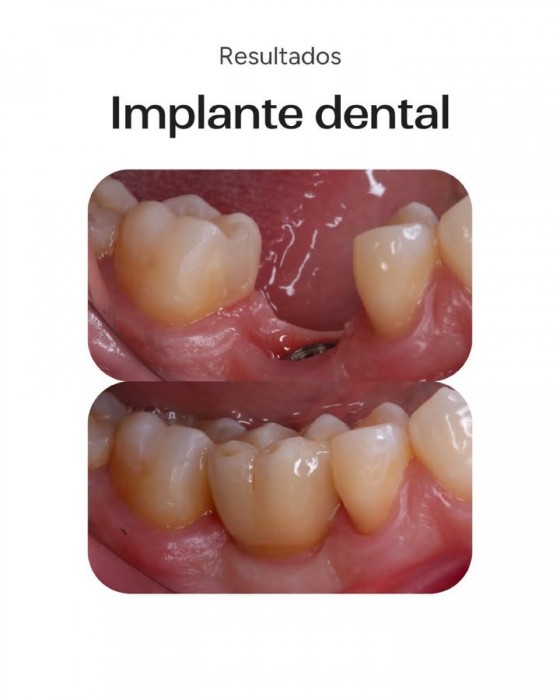 Tratamiento de implante osteointegrado