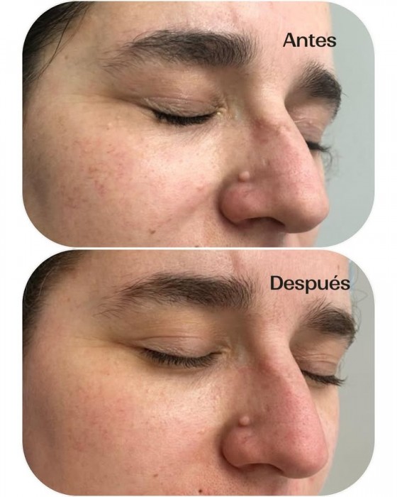 Tratamiento de IPL (Luz Pulsada) para tratar manchas en la cara