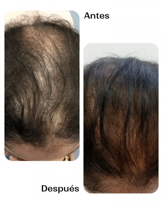 Tratamiento de mesoterapia capilar para recuperar el cabello
