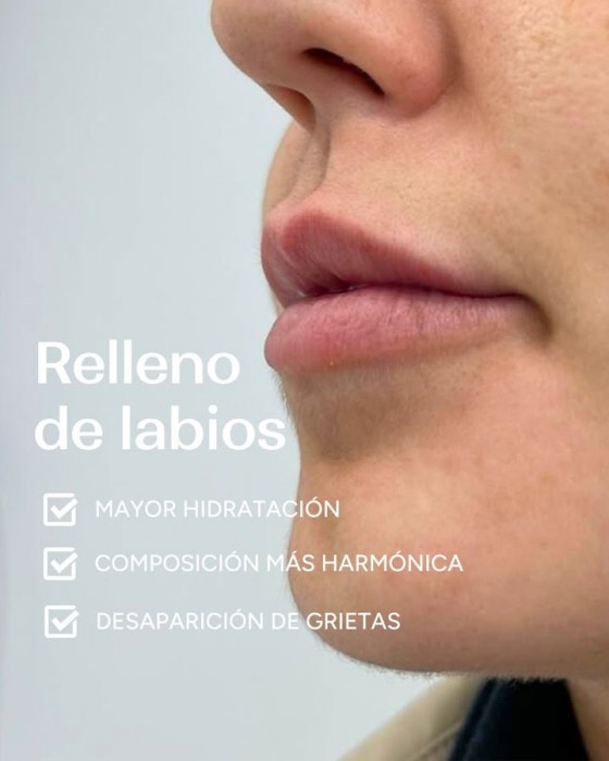 Tratamiento de relleno de labios con ácido hialurónico