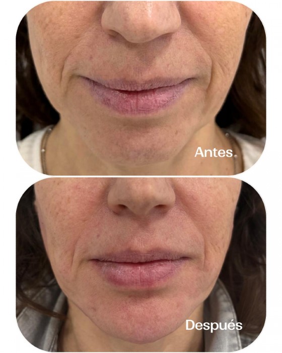 Tratamiento facial con ácido hialurónico