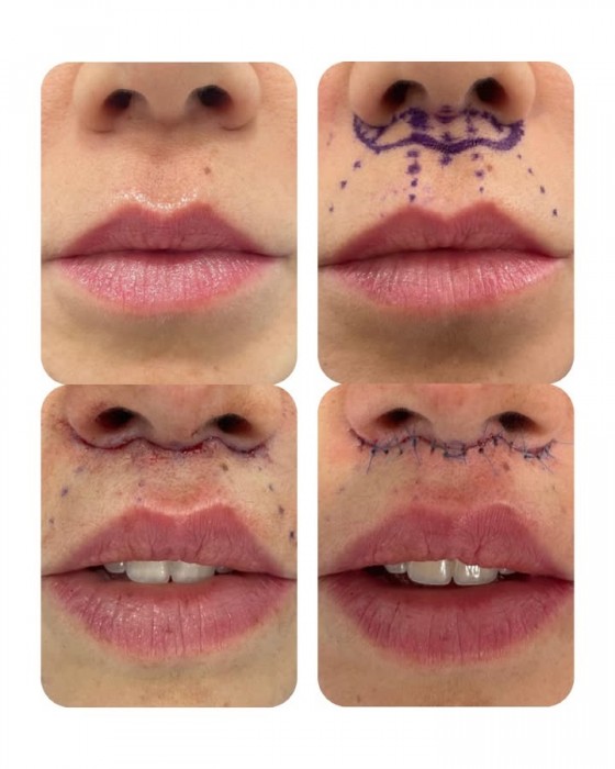 Tratamiento Lip lift en los labios